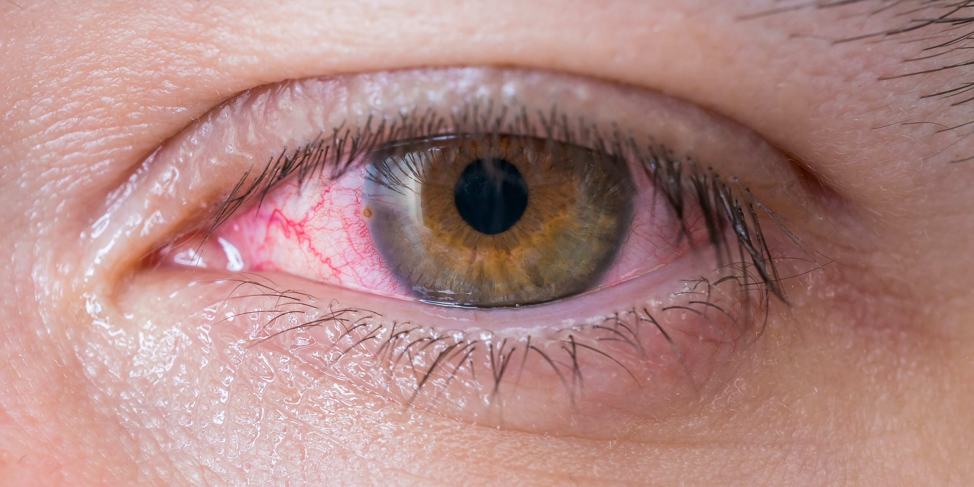 Причины красных глаз