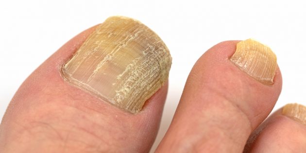 Дерматомикоз: грибок ногтя