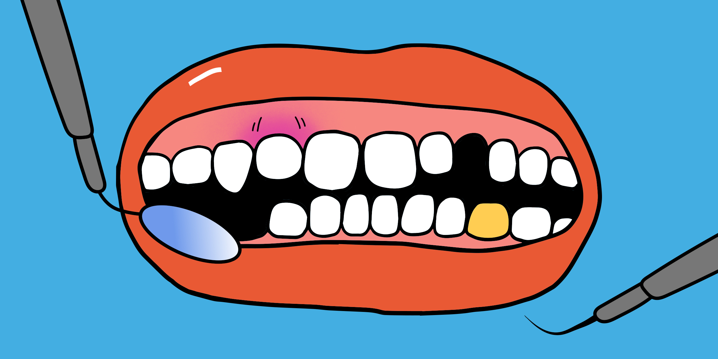 Зубы шатаются - в чем причина и что делать